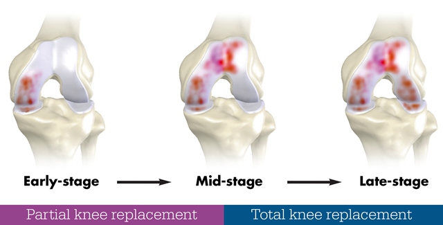 knee joint degradation