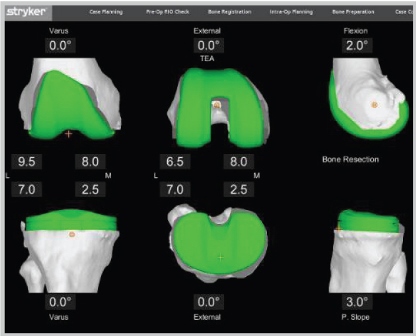 knee personalized plan