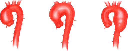 dilated aortic arch dilated aortic arch