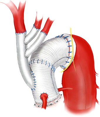 arch with trigraft